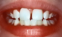 Perfect Smile repaired central incisors